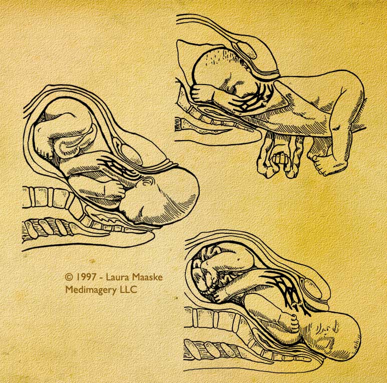 three depictions revealing the types of brachial plexus injuries which might occur in a newborn infant