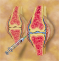 © Merck Phramaceutical
Title: Fluid Effusion for Osteoarthritis
Author: Laura Maaske
Description: Drainage for fluid effusion of osteoarthritis