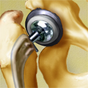 © Merck Phramaceutical
Title: Artificial Pelvic Hip Joint
Author: Laura Maaske
Description: Ball and socket artifical joint for arthritic hip joint