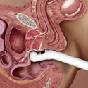 © Merck Phramaceutical
Title: Atherosclerosis
Author: Laura Maaske
Description: Development of an atherosclerotic plaque