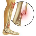 © Laura Maaske
Title: Leg Injuries
Description: Medical Legal illustration depicting leg injuries endured related to pedestrian auto accident