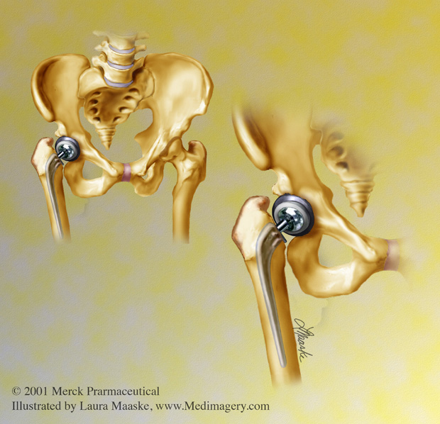 Pelvic Hip Replacement Illustrated by Laura Maaske
