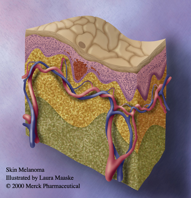 Melanoma Illustrated by Laura Maaske