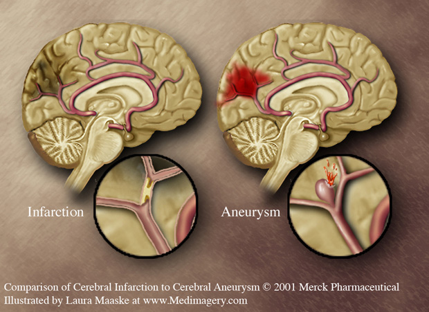 brain-aneurysm-Anatomy-Medical-illustration-Copyrighted-Material-by-Laura-Maaske-Medical-Illustrator-www.medimagery.com