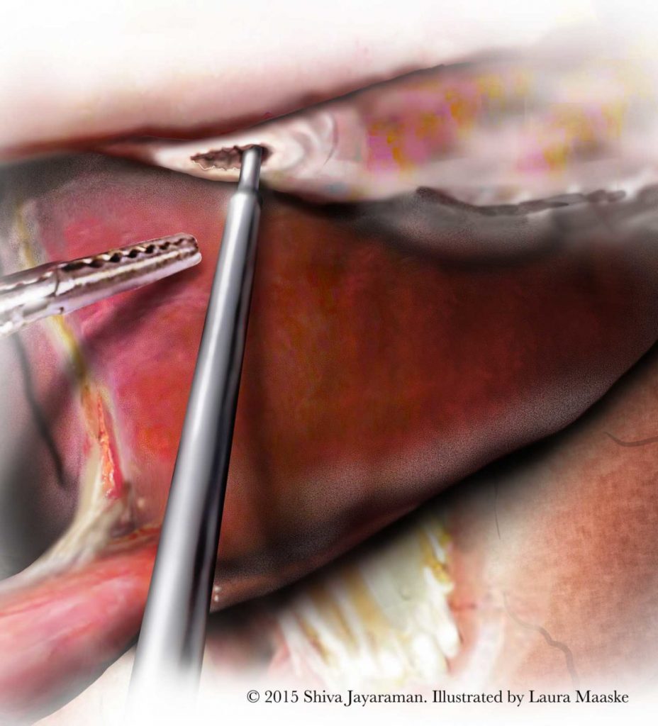 Surgical Slide: Releasing the Falciform Ligament. Laparoscopic Left Lateral Liver Sectionectomy. Surgical Illustration. Medical Anatomical Illustration Illustrated by Medical Illustrator Laura Maaske LLC. Copyrighted Material. Do not print without permission. www.mediamgery.com