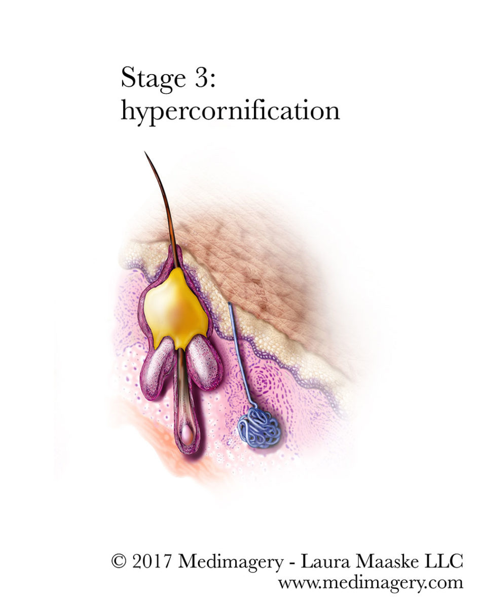 4-acne-hypercornification-Maaske.jpg