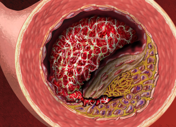 thrombus artery atherosclerosis medical legal illustration trial exhibit medical Illustration. Copyrighted Material Illustrated by Laura Maaske Medical Illustrator, Medical Animator, Biomedical Communicator, & biological artist. For permission information contact the artist