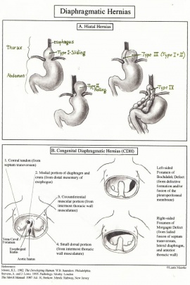 diaphragmatic hernia types
